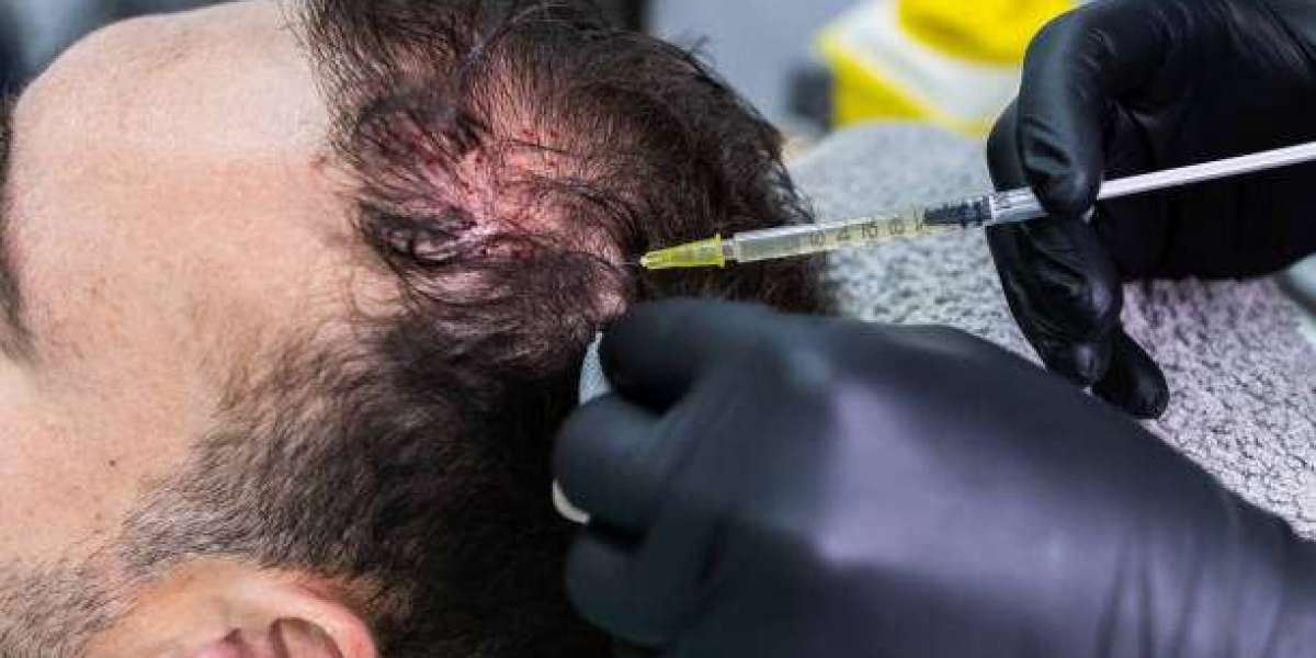 PRP Injections for Hair: Your Path to Thicker, Healthier Scalp Growth