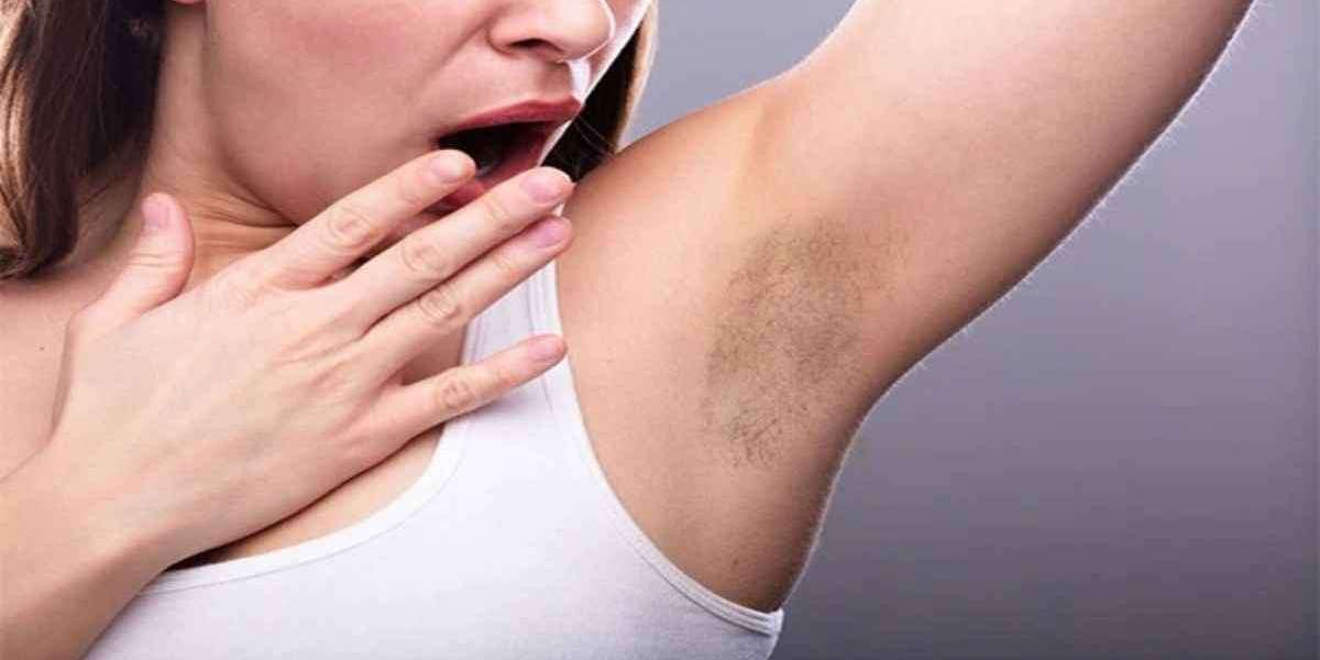 SKN Cosmetics – Trusted Sweaty Armpits Treatment in Islamabad