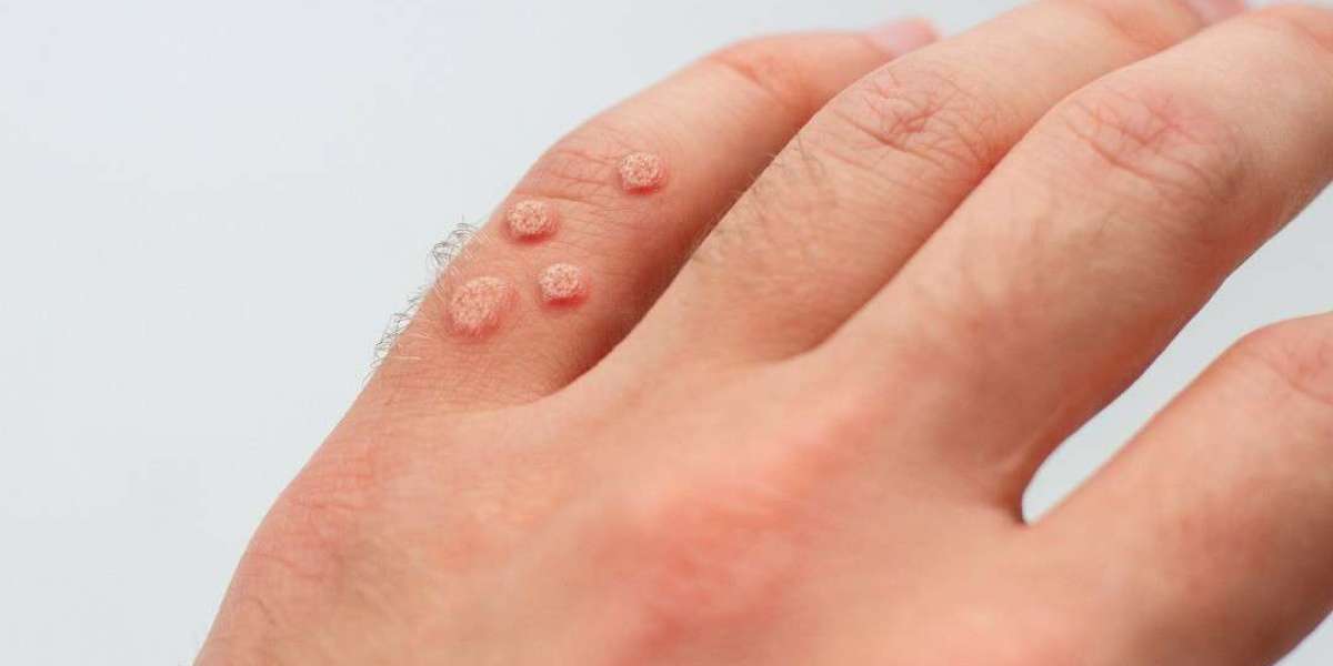 Wart Removal in Minutes: Is It Possible?