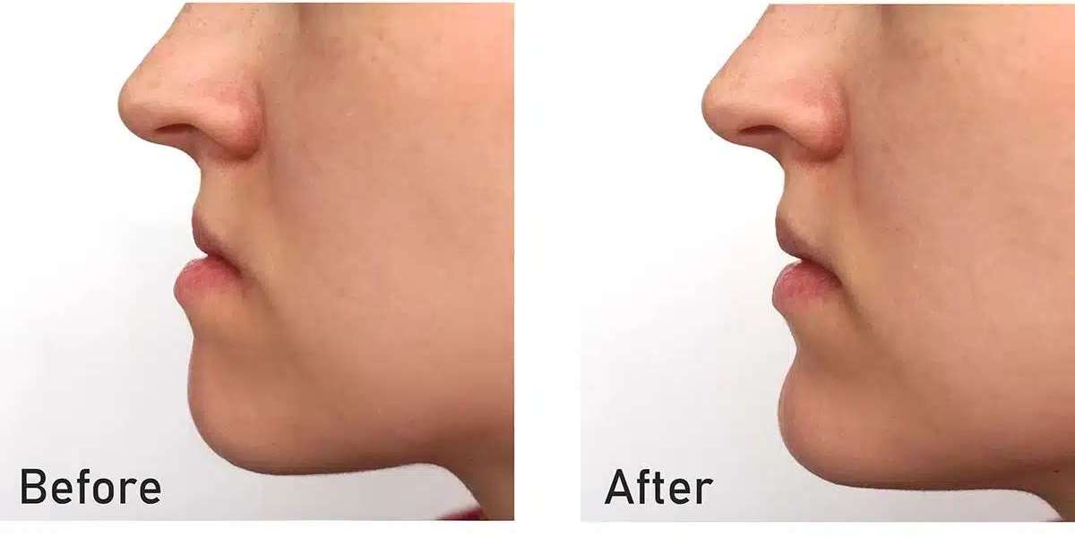 From Function to Aesthetics: The Power of Orthognathic Surgery