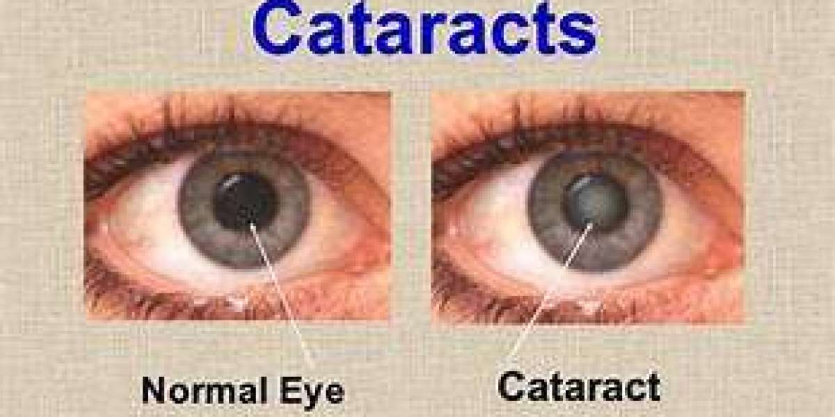 Understanding Mild Cataracts for Early Eye Care and Clear Vision