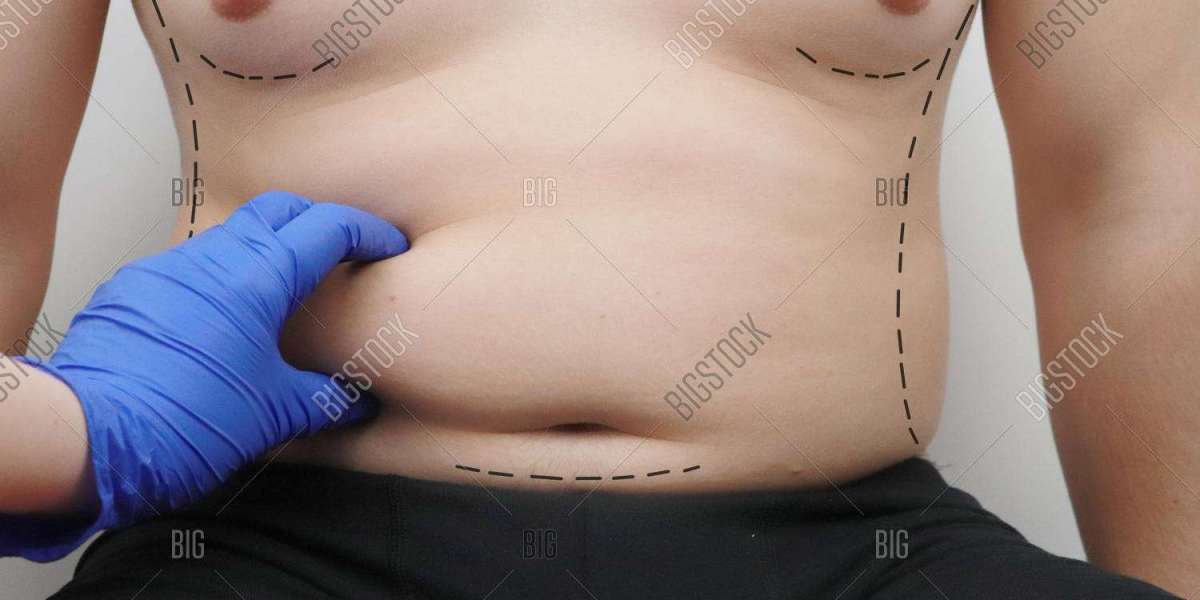 Tummy Tuck Surgery (Abdominoplasty) in Islamabad – Complete Overview.