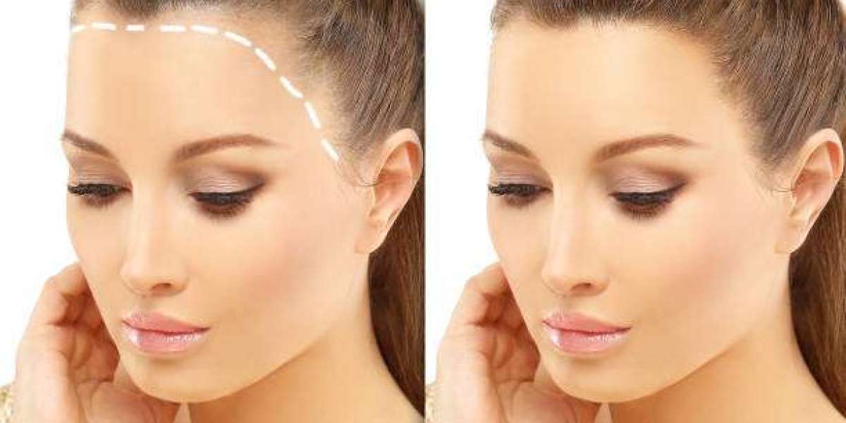 Hair Transplant Recovery Tips for Saudi Arabia Patients