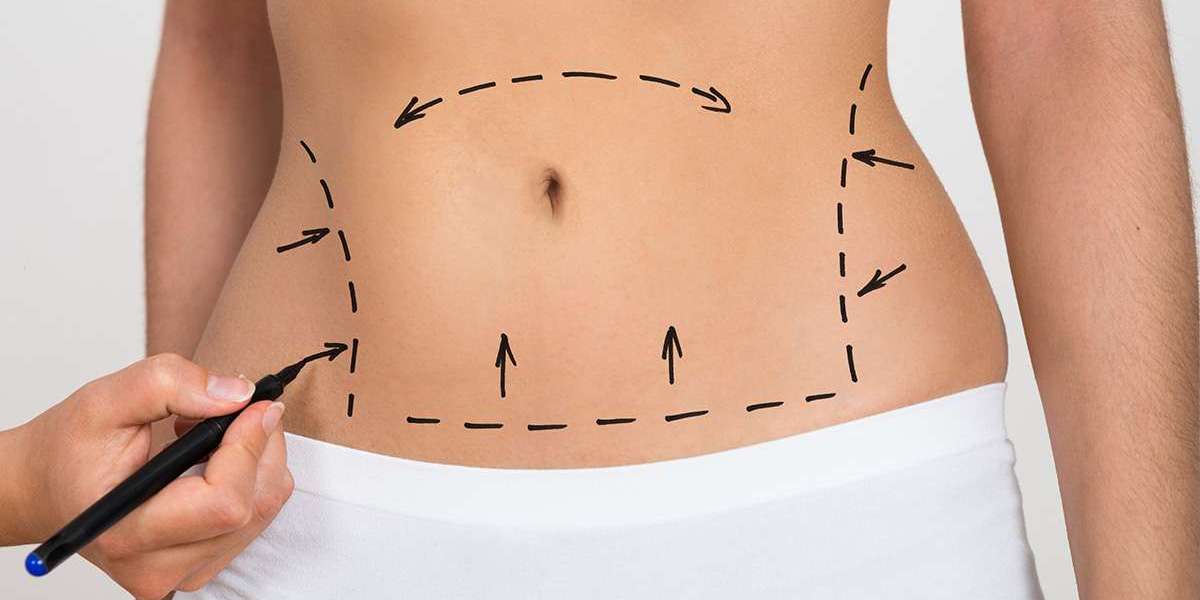 Bariatric Surgery in Islamabad: Step-by-Step Procedure Guide