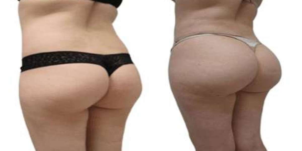 Buttock Augmentation in Dubai: A Complete Beginner’s Guide to Body Enhancement