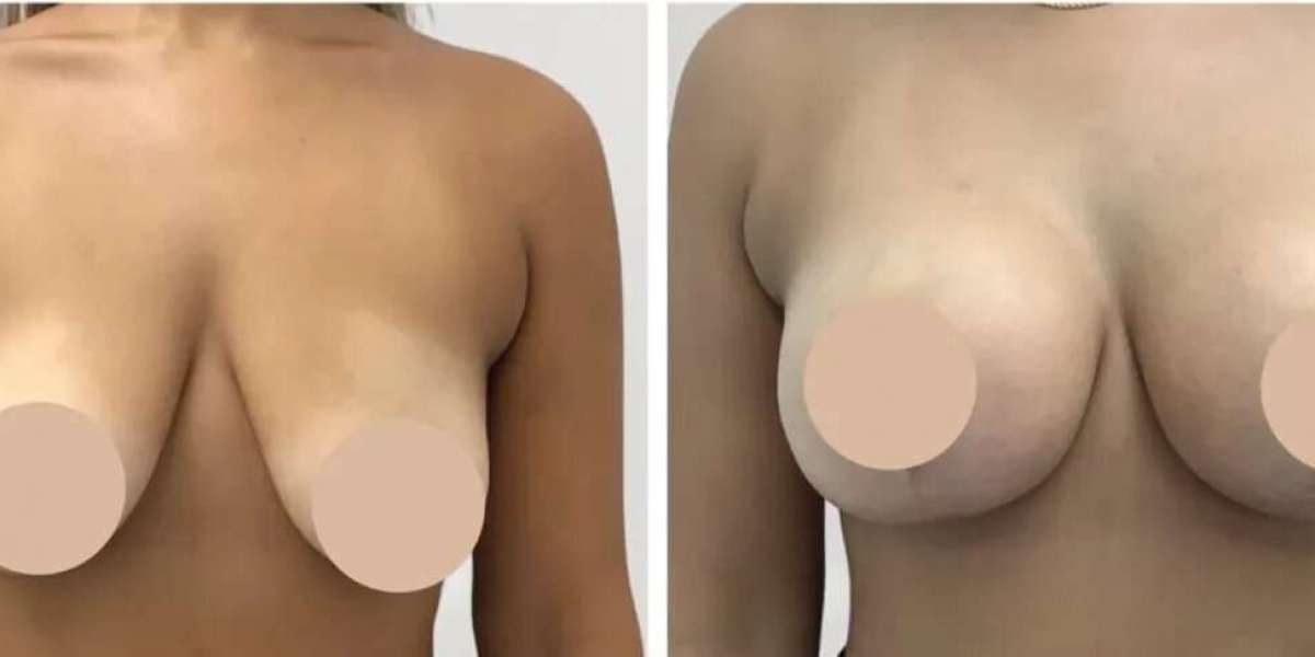 Breast Reduction Surgery in Dubai for Proportionate Contours