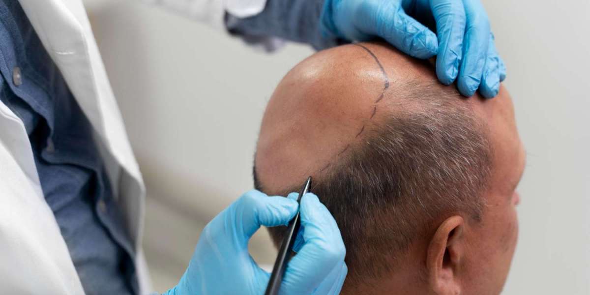 1000 Grafts Hair Transplant Cost: 2026 Guide