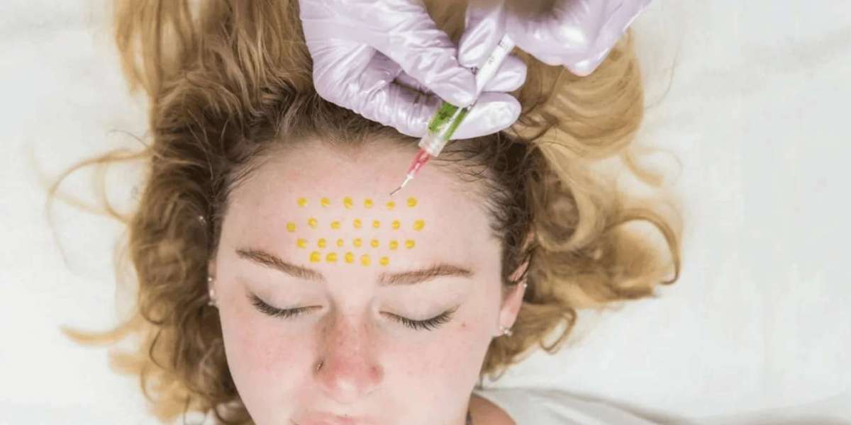 Does BioRePeel Cause Peeling or Downtime After Treatment?