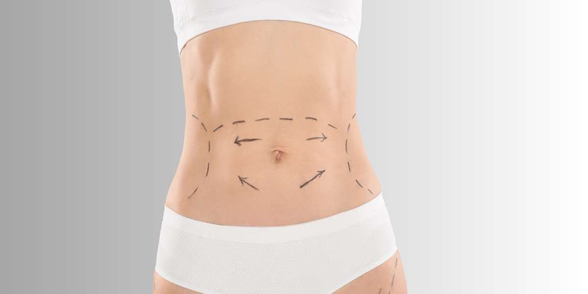 Laser Liposuction Results After One Month