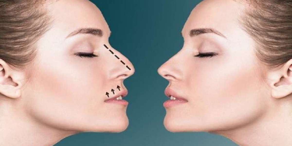 Timeless Elegance: Rhinoplasty Tips for Riyadh’s High-Society Brides