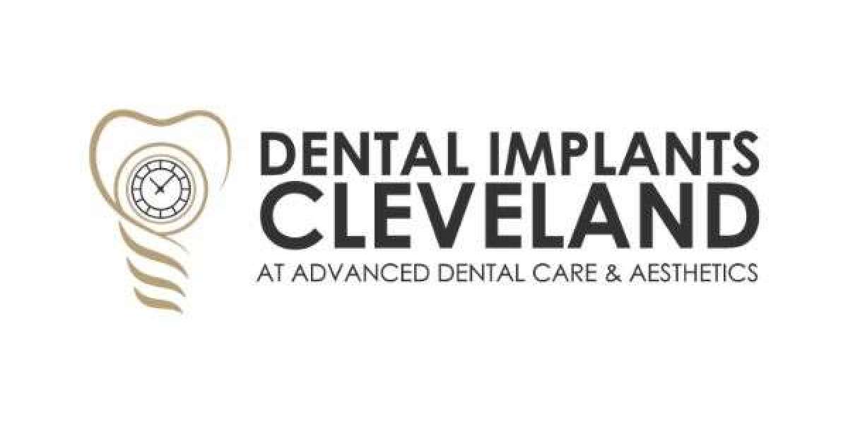 Full Mouth Dental Implants Cleveland OH by Dental Implants Cleveland