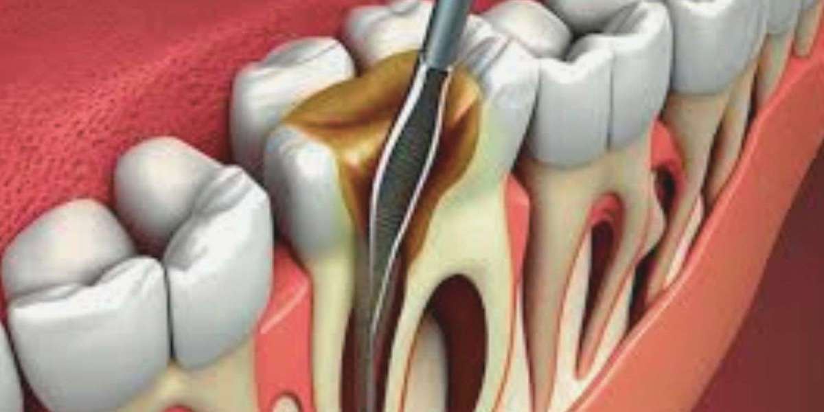How Root Canals Save Teeth and Improve Overall Health