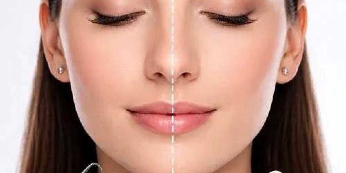 Female Rhinoplasty Cost in Islamabad – What to Expect