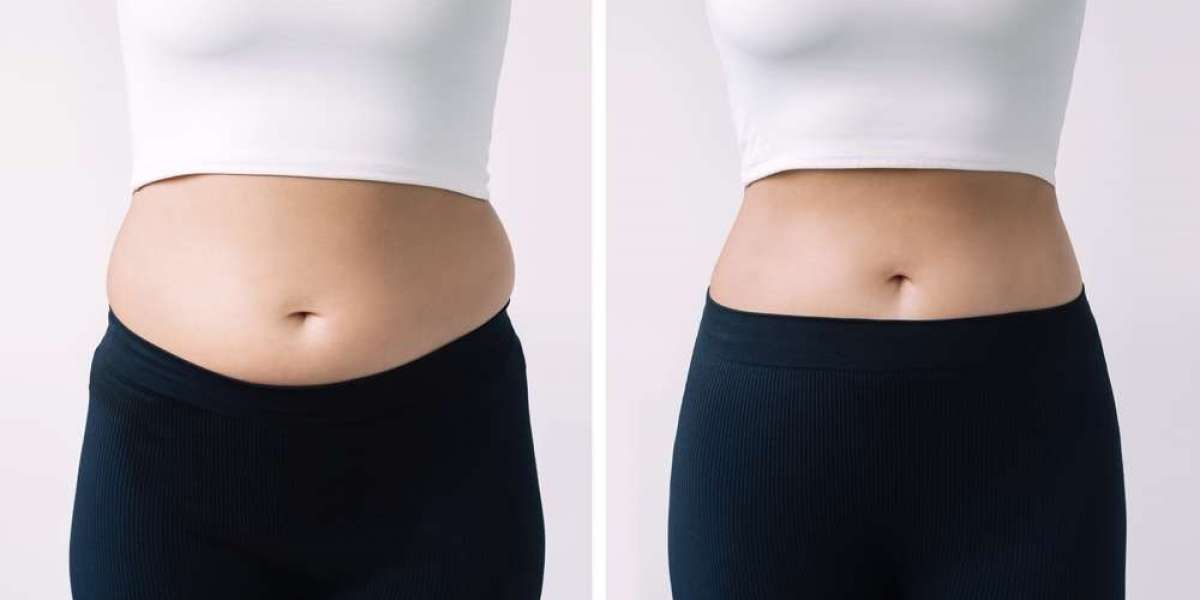 How Body Contouring in Dubai Shapes Your Figure