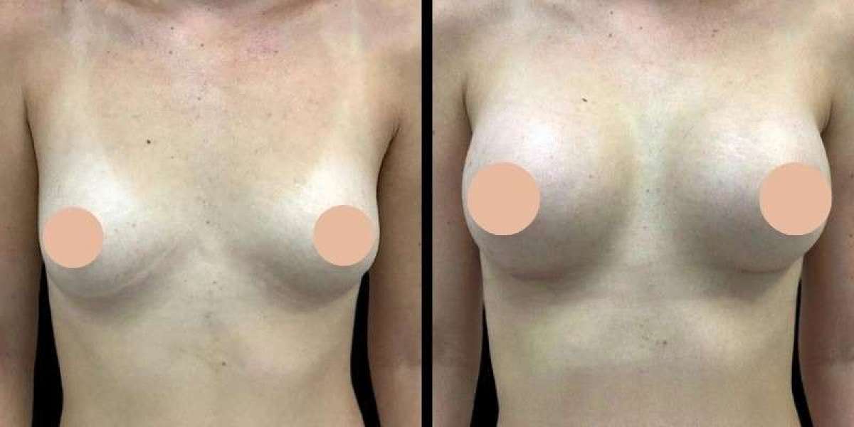 Why the Best Breast Augmentation Surgeons in Dubai Focus on Natural Results