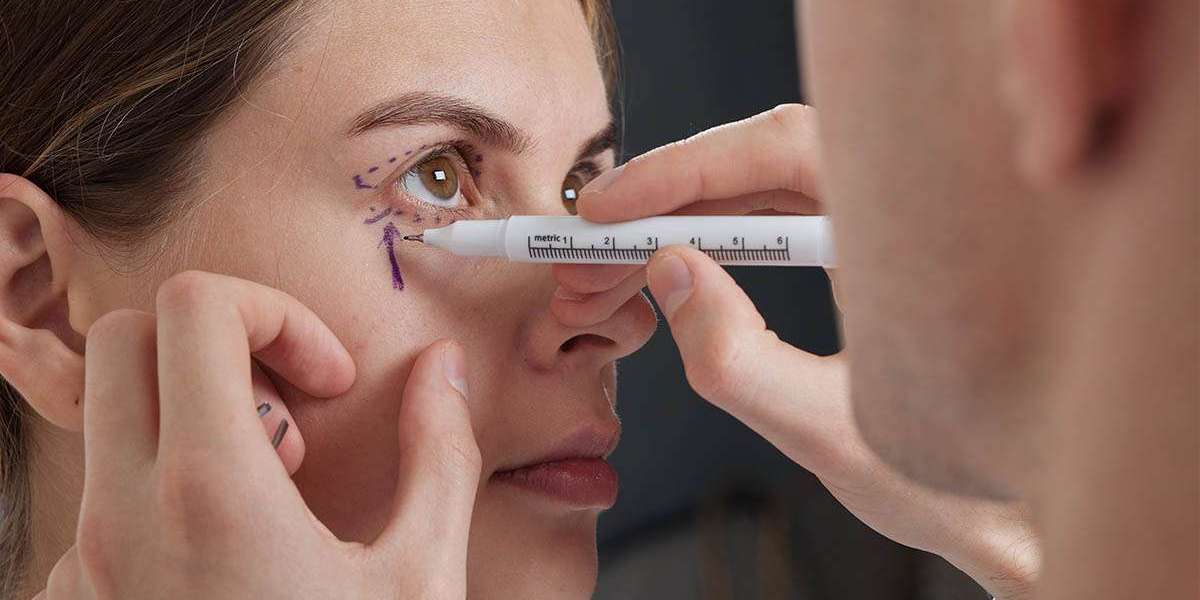 Managing Swelling and Bruising After Blepharoplasty