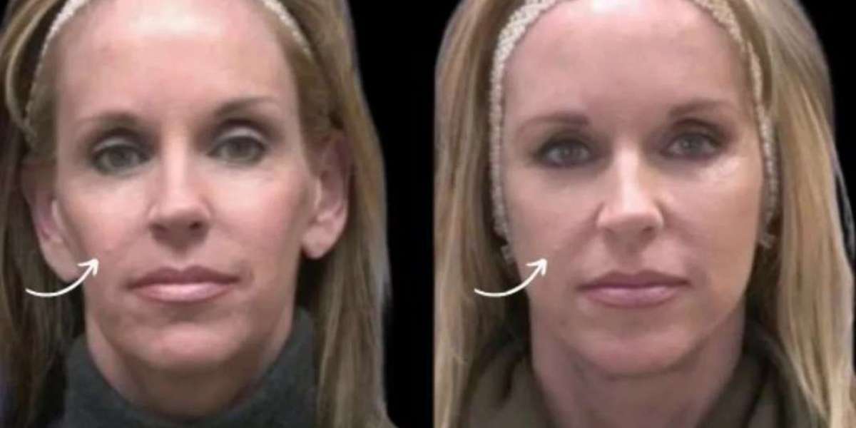 Sculptra Beauty Craftsmanship at the Best Aesthetic Clinic in Dubai