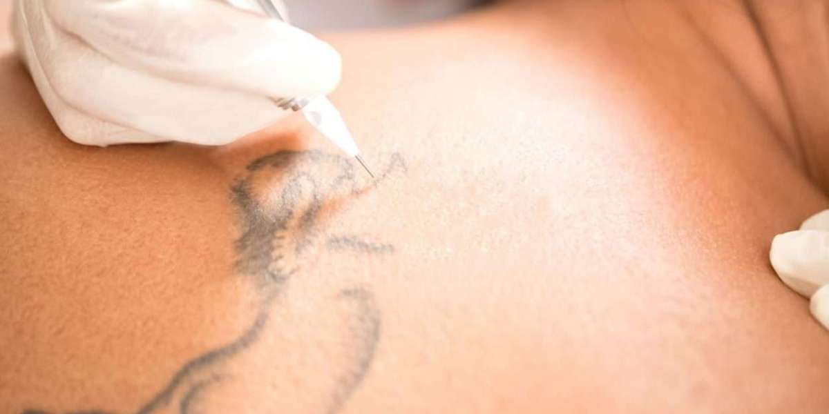 Tattoo Removal for Skin Sensitivity Issues
