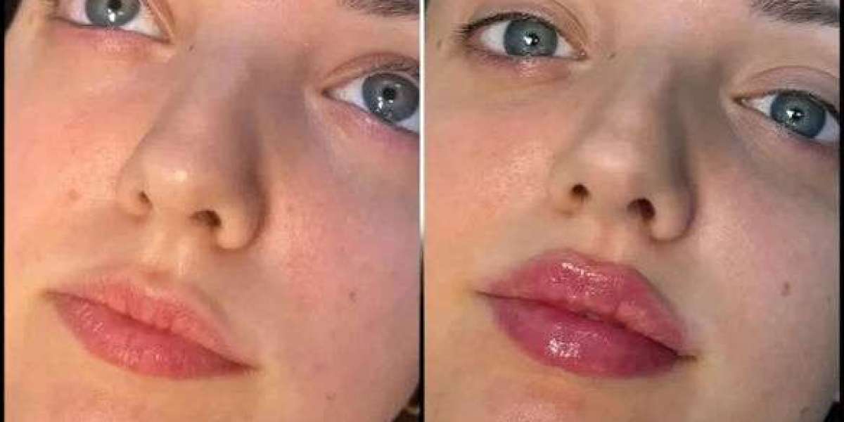 Transform Your Look with Fillers by Best Doctors in dubai