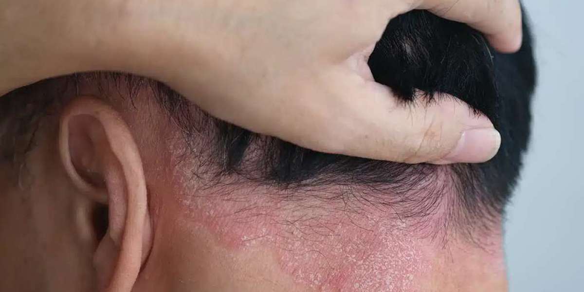 What Causes Burning Scalp Sensation and How to Fix It