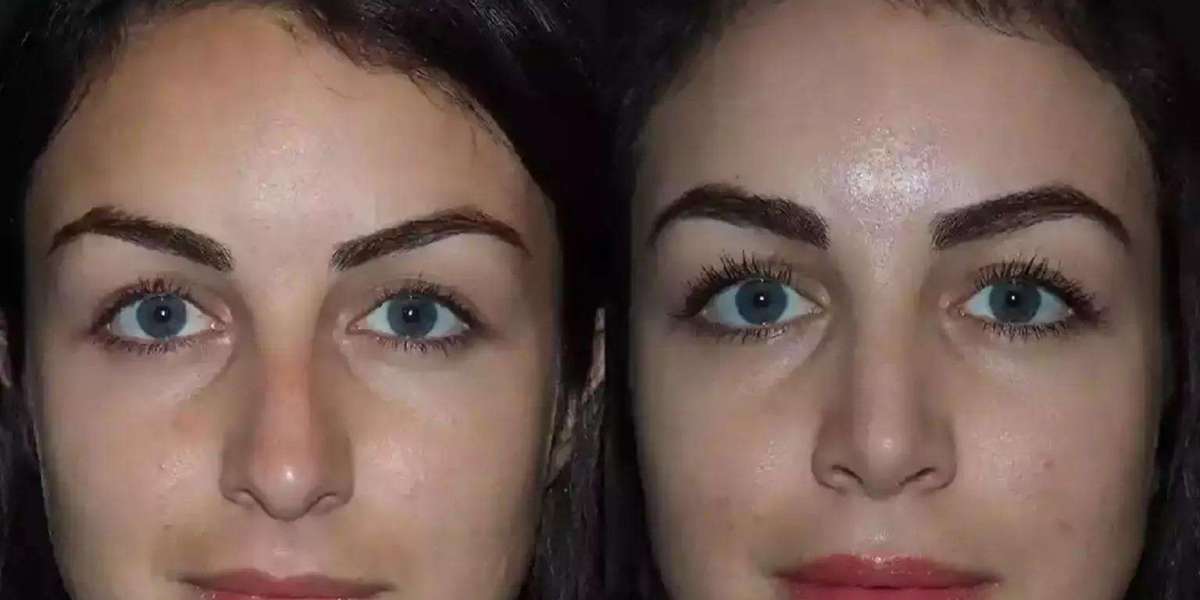 Best Doctors in Dubai Delivering Quality Septoplasty Care