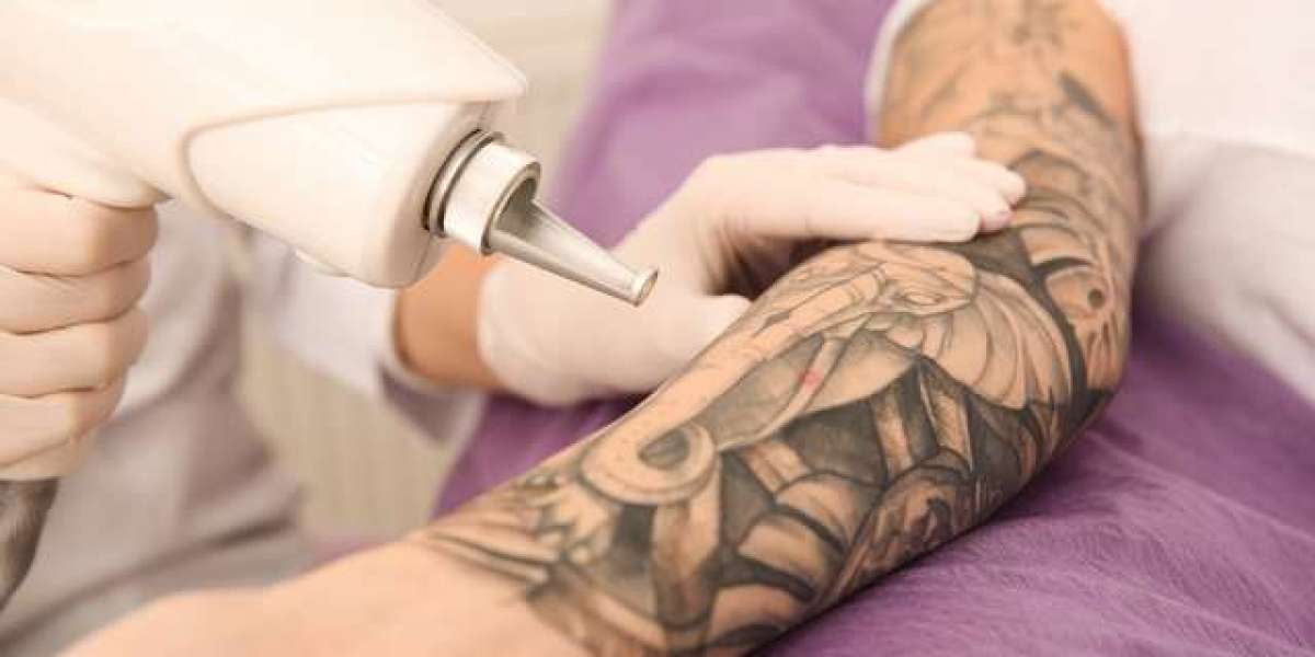 How Laser Tattoo Removal Works,A Complete Beginner’s Guide