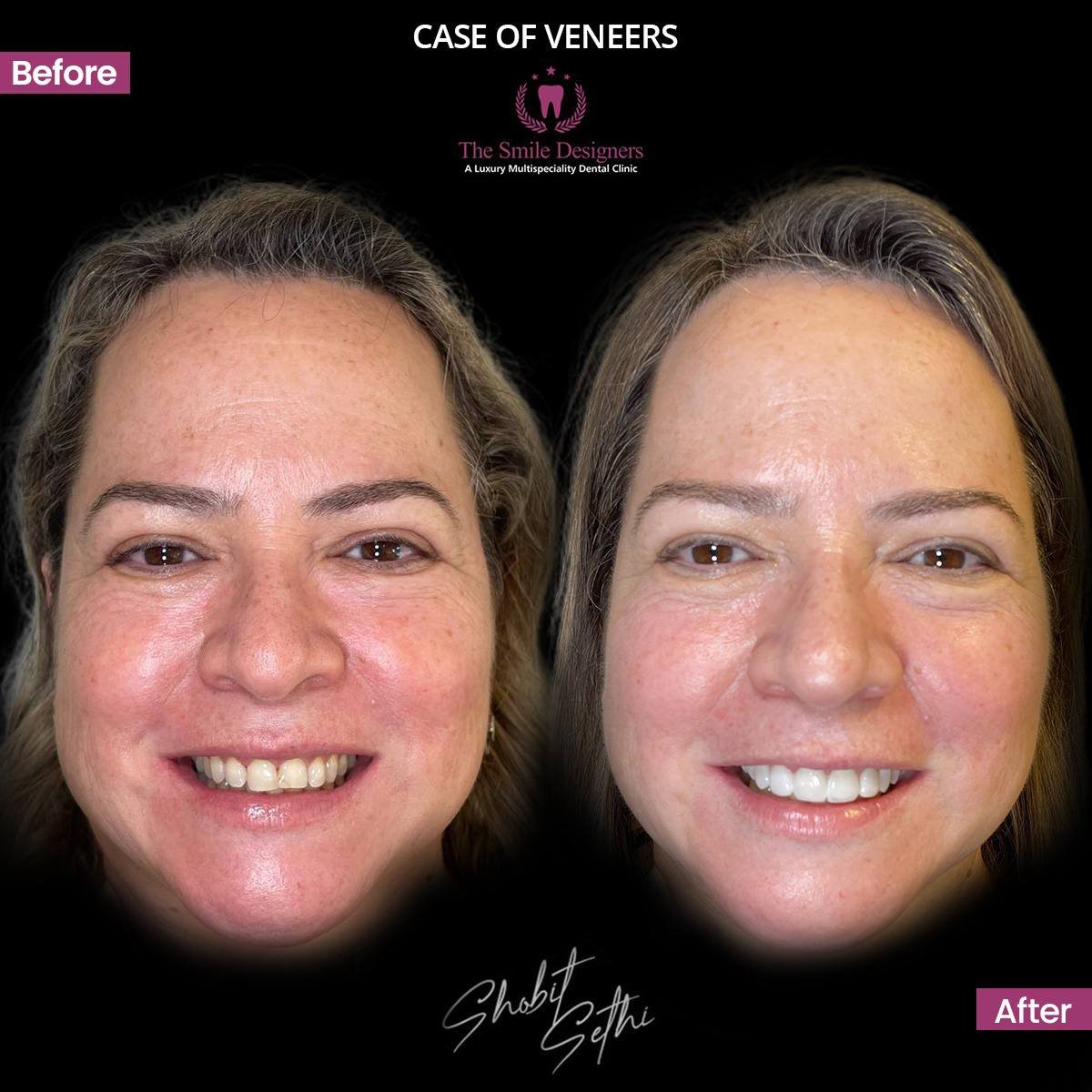 Dental Veneers in Chandigarh and Mohali