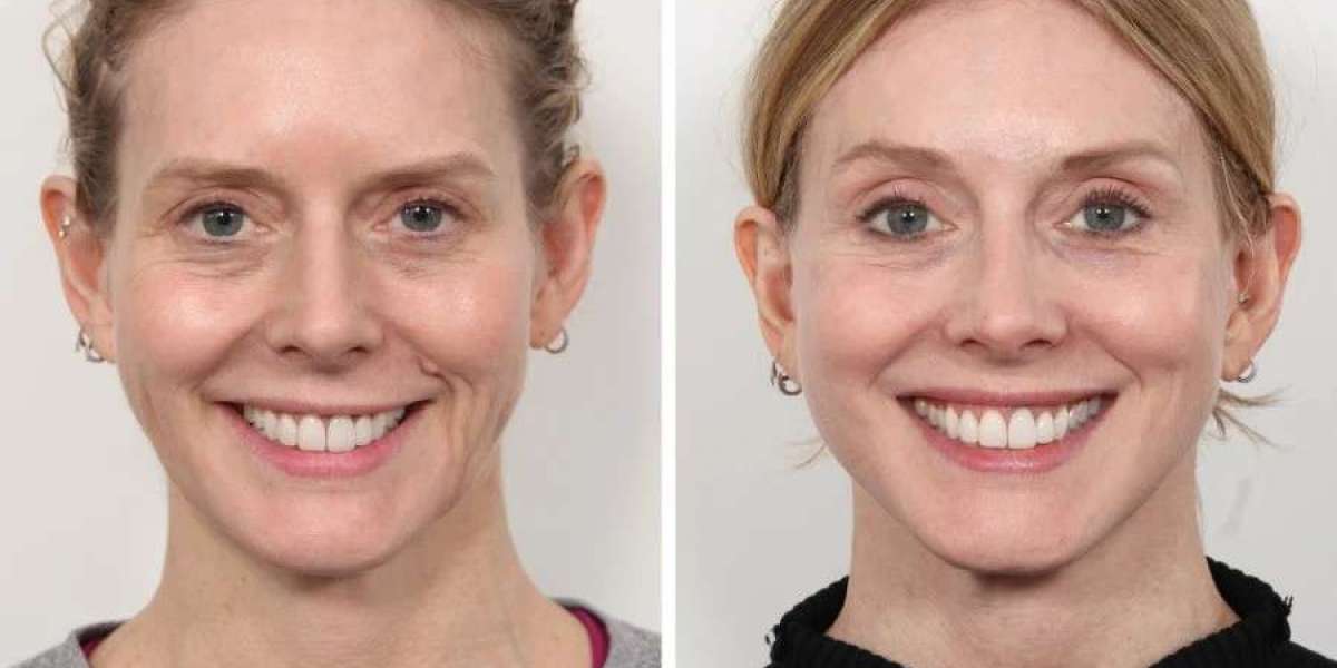 Best Doctors in Dubai for Thread Lift Advantages Explained