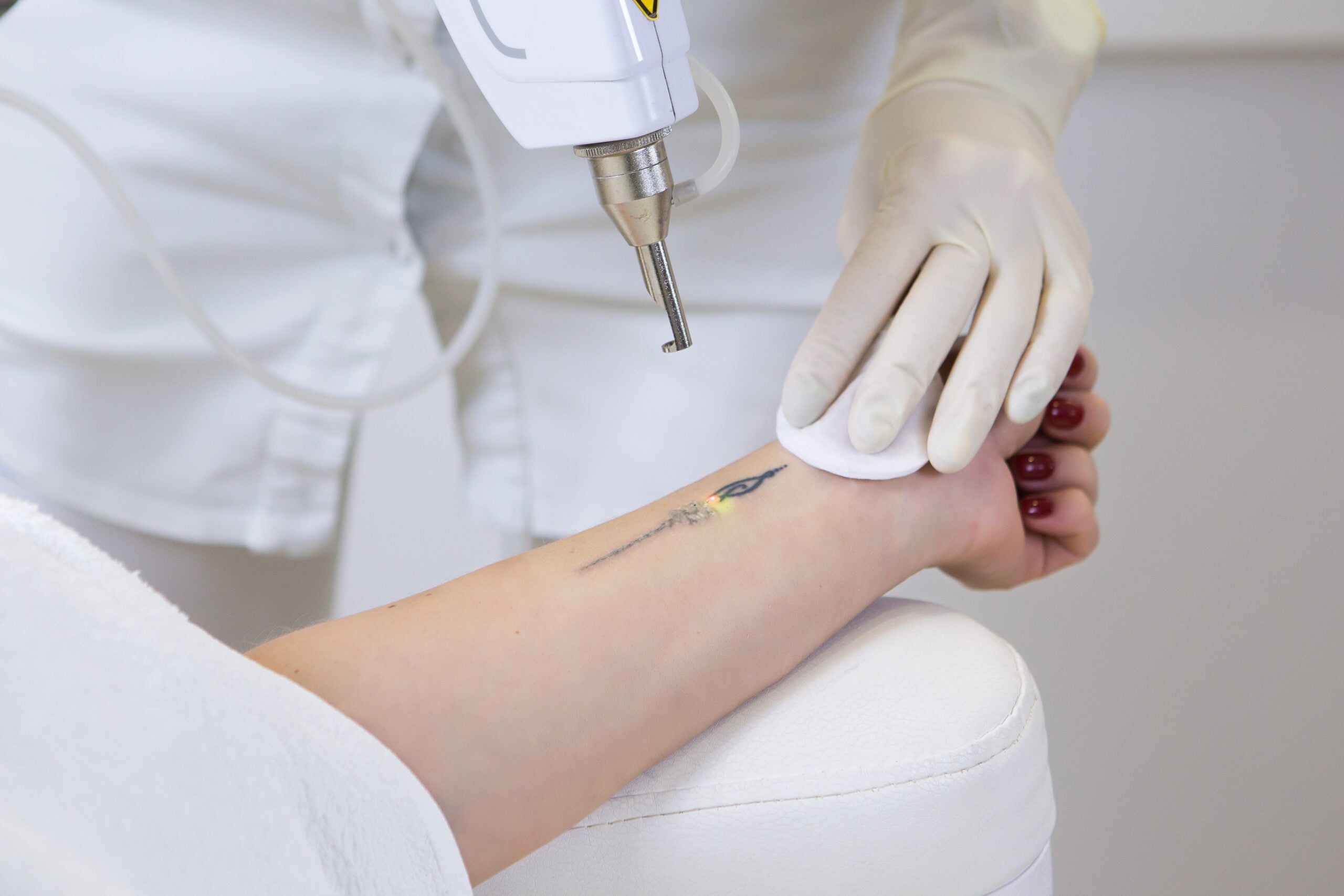 Laser Tattoo Removal Cost in Pune @ ₹1,000 Near Me