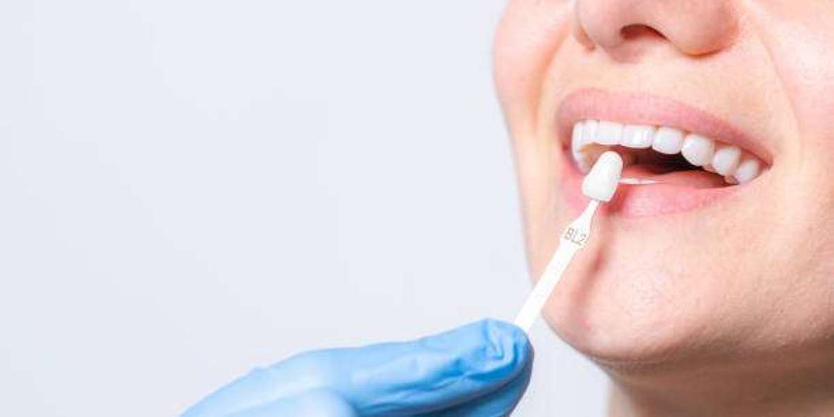 A Complete Guide to a Perfect Smile Makeover    Dental Veneers in Pakistan: