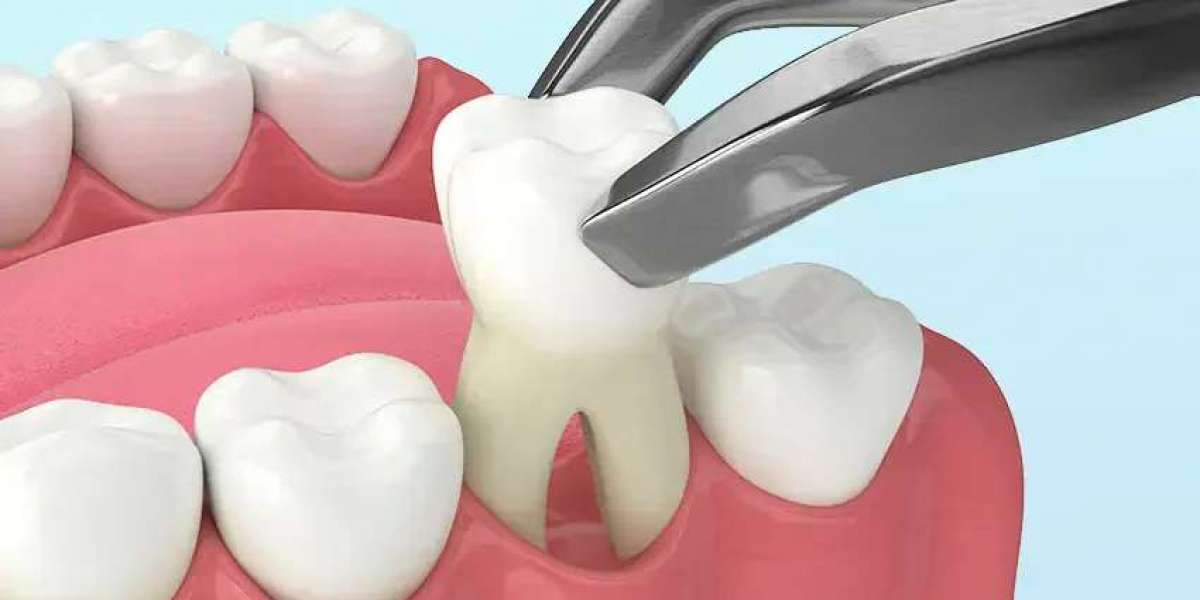 How Much Does Tooth Extraction Cost? Insights from a Dentist in Oshiwara
