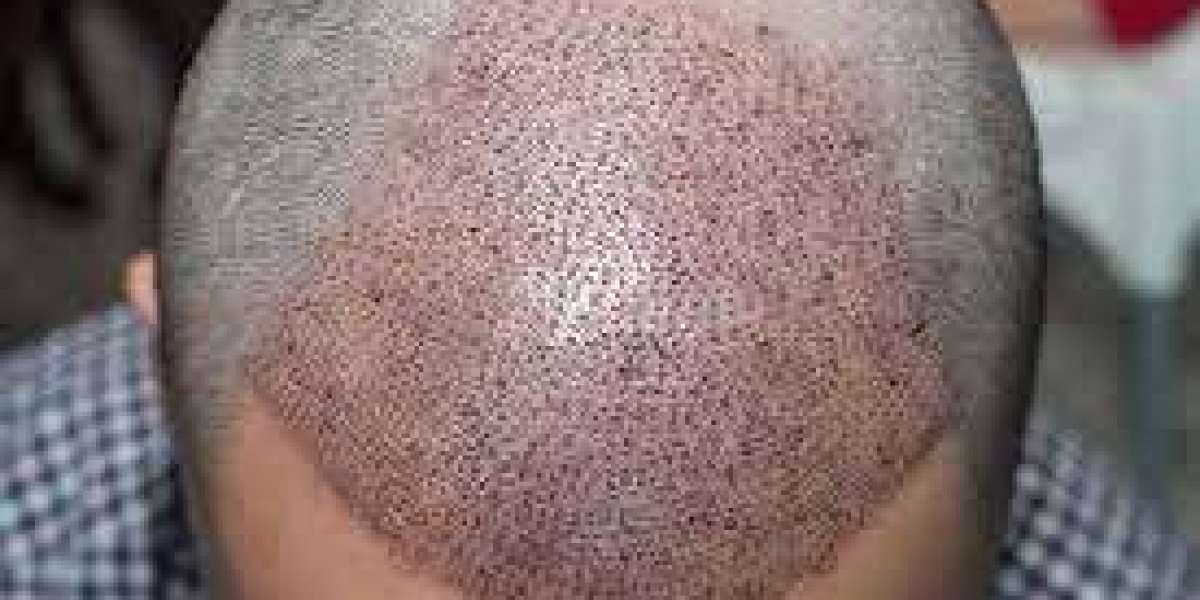 The Benefits of Hair Transplant in Dubai for Natural and Permanent Hair Restoration