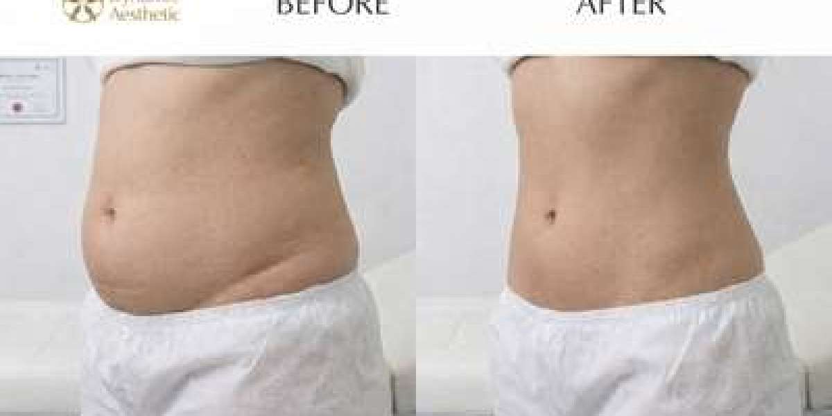Liposuction in Islamabad for a Sculpted Waistline