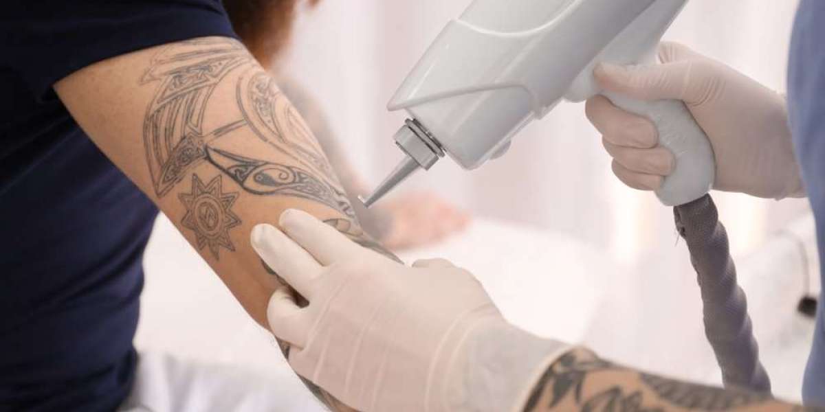 Common Reasons People Seek Tattoo Removal in Riyadh