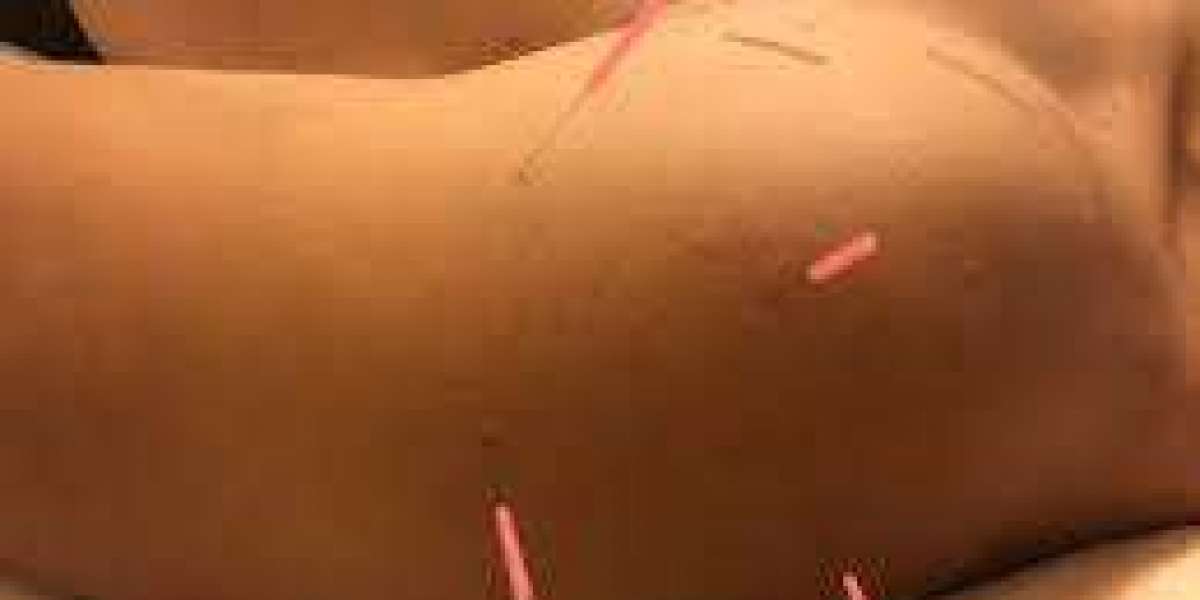Acupuncture For Shoulder Pain NYC