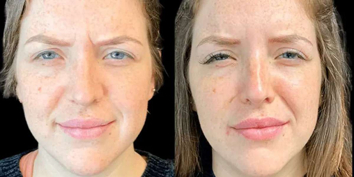 Best Doctors in Dubai for Forehead Botox & Frown Line Treatment