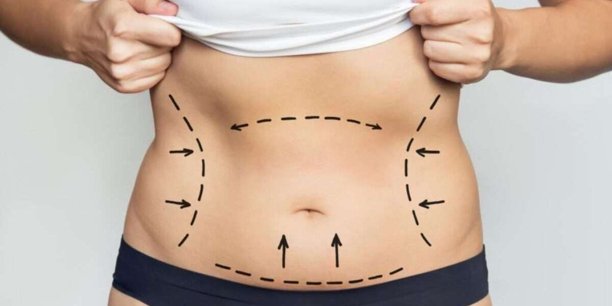 Transform Your Body with Best Liposuction Surgeons in Dubai