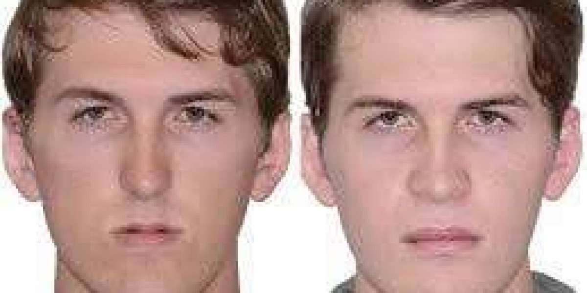 Jaw Surgery in Islamabad for Facial Asymmetry Correction