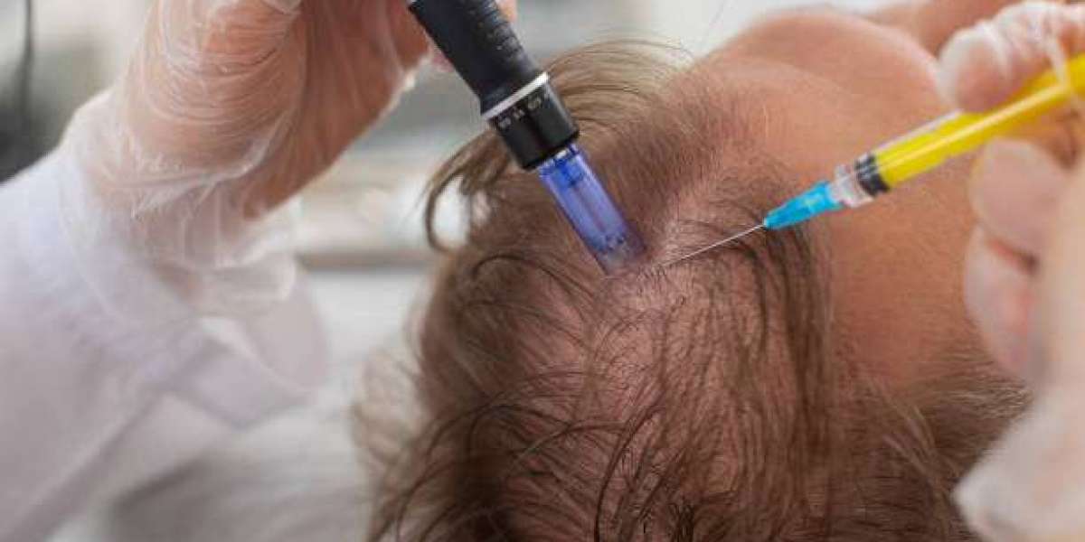 Exosome Hair Therapy vs PRP in Islamabad: Which Treatment Is Better?