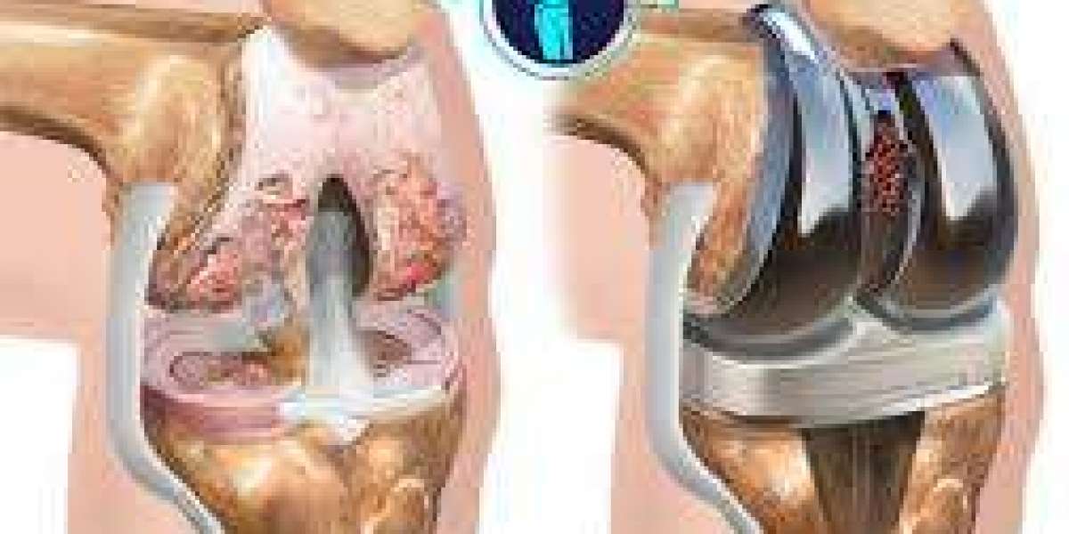 Cost of Knee Replacement Private Fast Access to Quality Care