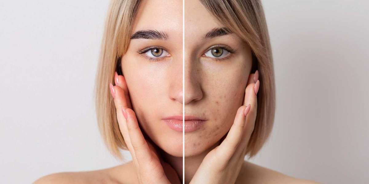 What is Preservation Rhinoplasty? The Latest Trend in Nose Surgery