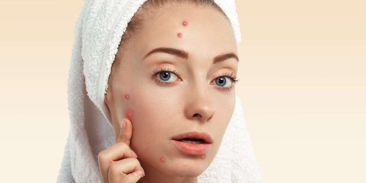 How Do Skin Doctors Determine Different Acne Treatments?