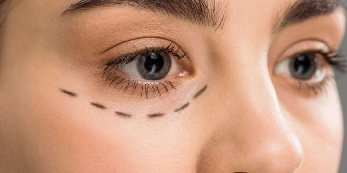 Blepharoplasty for Wrinkles Around the Eyes