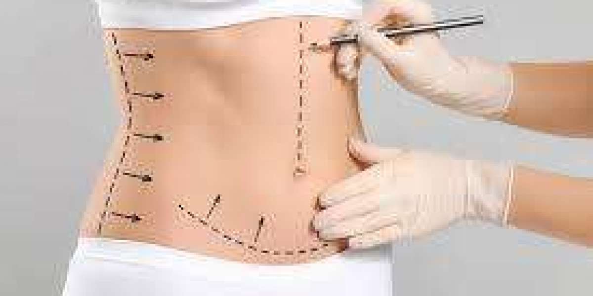 Is tummy tuck surgery painful or manageable?