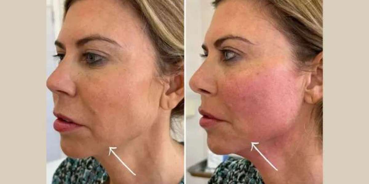 Best Doctors in dubai Delivering Personalized Endolift Facial Tightening Procedures