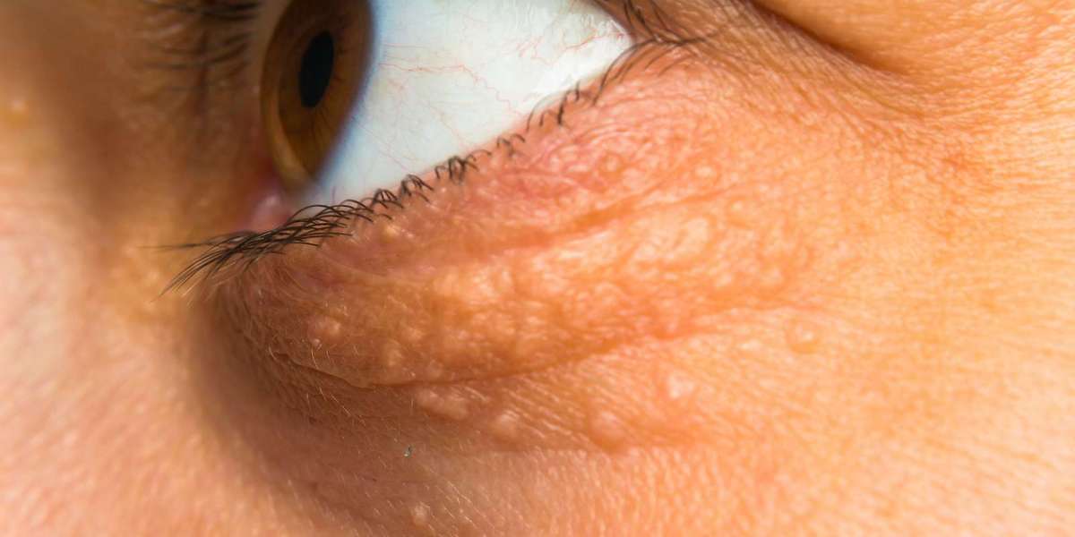 Eyelid Xanthelasma Removal: Does it brighten tired eyelids effectively?