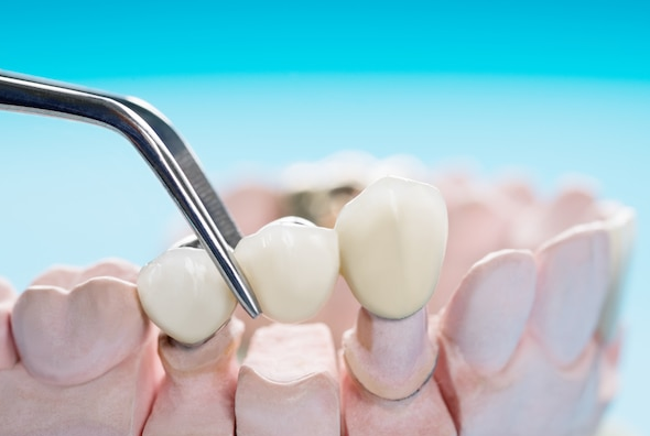 Everything You Need to Know About Dental Bridges: Enhance Your...