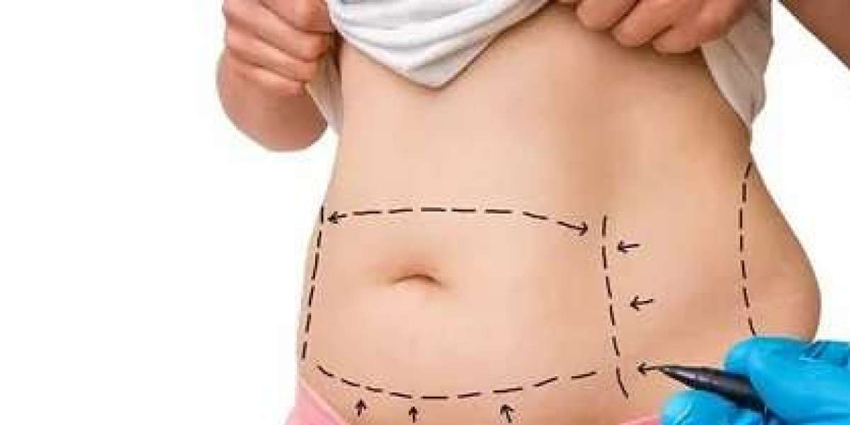 Liposuction in Islamabad: Procedure, Recovery, and Results