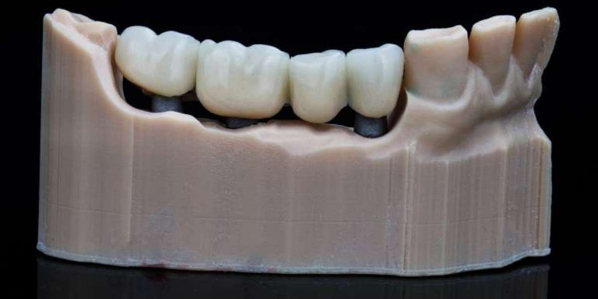 Can Dental Bridges Prevent Teeth Shifting After Tooth Loss?