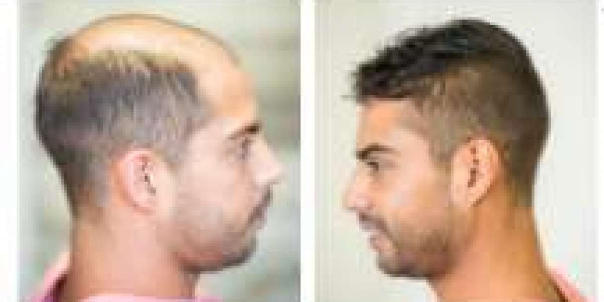 Hollywood Lace Hair Systems: A Modern Solution for Natural-Looking Hair Replacement